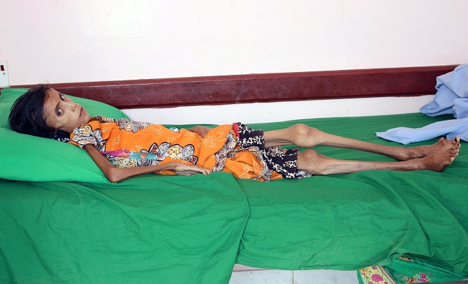 Malnourished Fatima Ibrahim Hadi, 12, who weighs just 10 kg lies on a bed at a clinic Aslam of the northwestern province of Hajjah, Yemen.