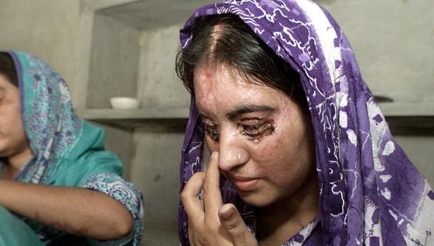 Sakeena (L), suffered burns to 70 percent of her body when her husband threw acid on her.