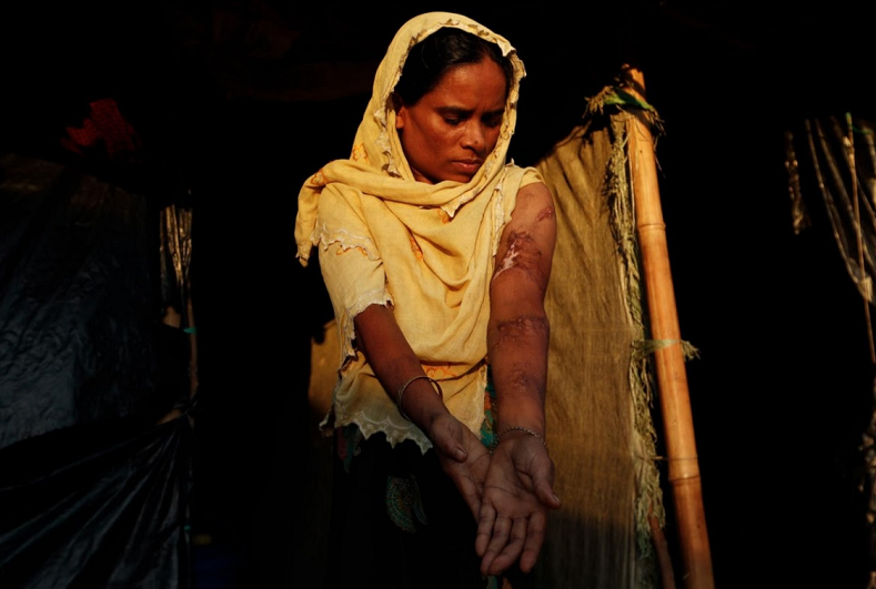 Anwara Begum, 36, said she awoke to find her home in Maungdaw township, in the northernmost part of Rakhine state, in flames. Before she could get out, the burning roof caved in on her and her nylon clothes melted onto her arms. Her husband carried her for eight days to reach the Kutupalong camp. 