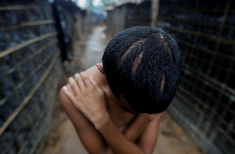 Nur Kamal, 17, shows his injuries.  Bowing to display the deep cuts arcing across his scalp, Kamal described how soldiers assaulted him after they found the young shopkeeper hiding in his home in Kan Hpu village in Maungdaw. “They hit me with a rifle butt on my head first and then with a knife,” Kamal said. His uncle found him unconscious in a pool of blood. It took them two weeks to get to Bangladesh.  “We want justice,” Kamal said. “We want the international community to help us obtain justice.”