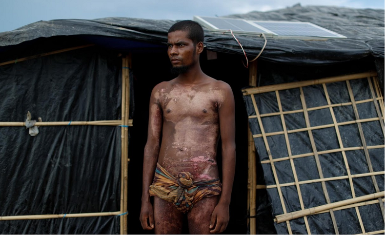 Mohamed Jabair, 21, show injuries he sustained when his house was set on fire in Myanmar. Suffering burns to his limbs and torso, Jabair feared he had also lost his sight in an explosion that ripped through his village home. Knocked unconscious and badly burned, Jabair was carried by his brother and others for four days to Cox's Bazar. 