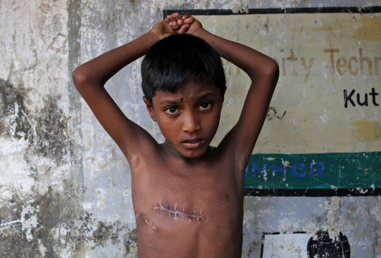 Mohammed Shoaib, 7, who was shot in his chest before crossing the border from Myanmar in August, shows his injury outside a medical centre after seeing a doctor, at Kutupalong refugee camp near Cox's Bazar, Bangladesh.