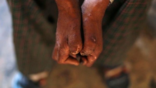  Leprosy is a skin disease which can be broken into two types, multibacillary and paucibacillary. 
