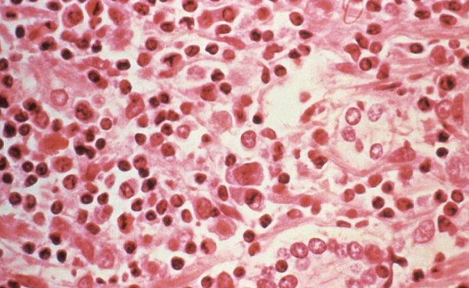 A micrographic study of liver tissue seen from a Hantavirus pulmonary syndrome (HPS) patient seen in this undated photo obtained by Reuters, July 6, 2017.
