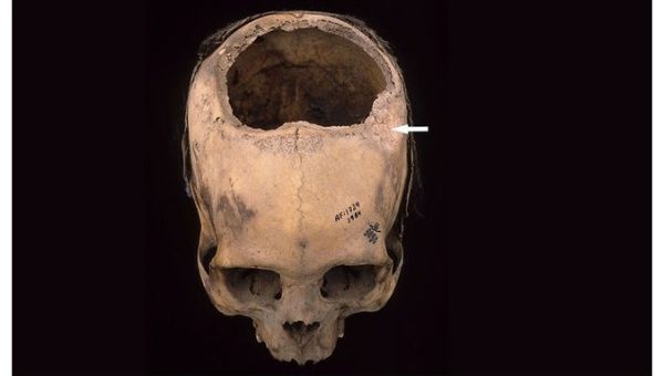 Here is the skull of an Incan community member who lived between between 400 and 200 B.C.E. and died shortly after suffering a skull fracture.