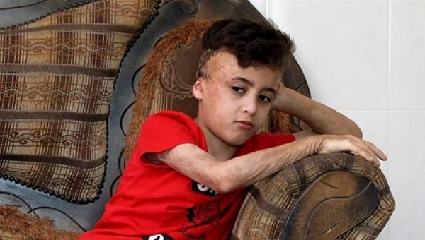 Ahmed Dawabsheh, the survivor of the arson attack that killed his parents and 18-month-old brother, in his grandparents' home.